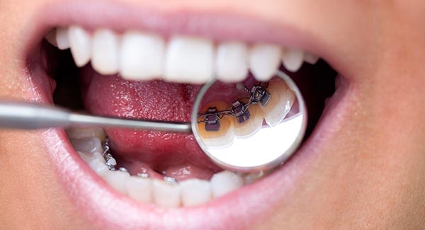 Patient mit innenliegender Incognito Zahnspange mittels Lingualtechnik