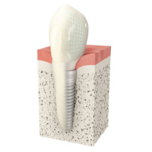 Modell Zahnimplantat mit Krone
