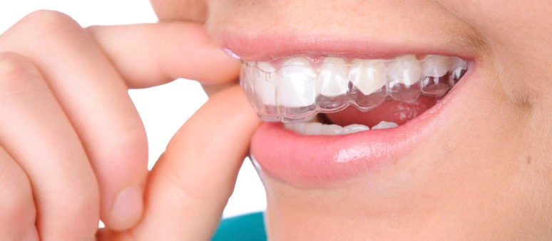 Einsetzen einer durchsichtigen Invisalign Zahnschiene