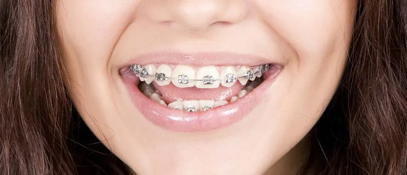Jugendliche Patientin mit festsitzender Zahnspange
