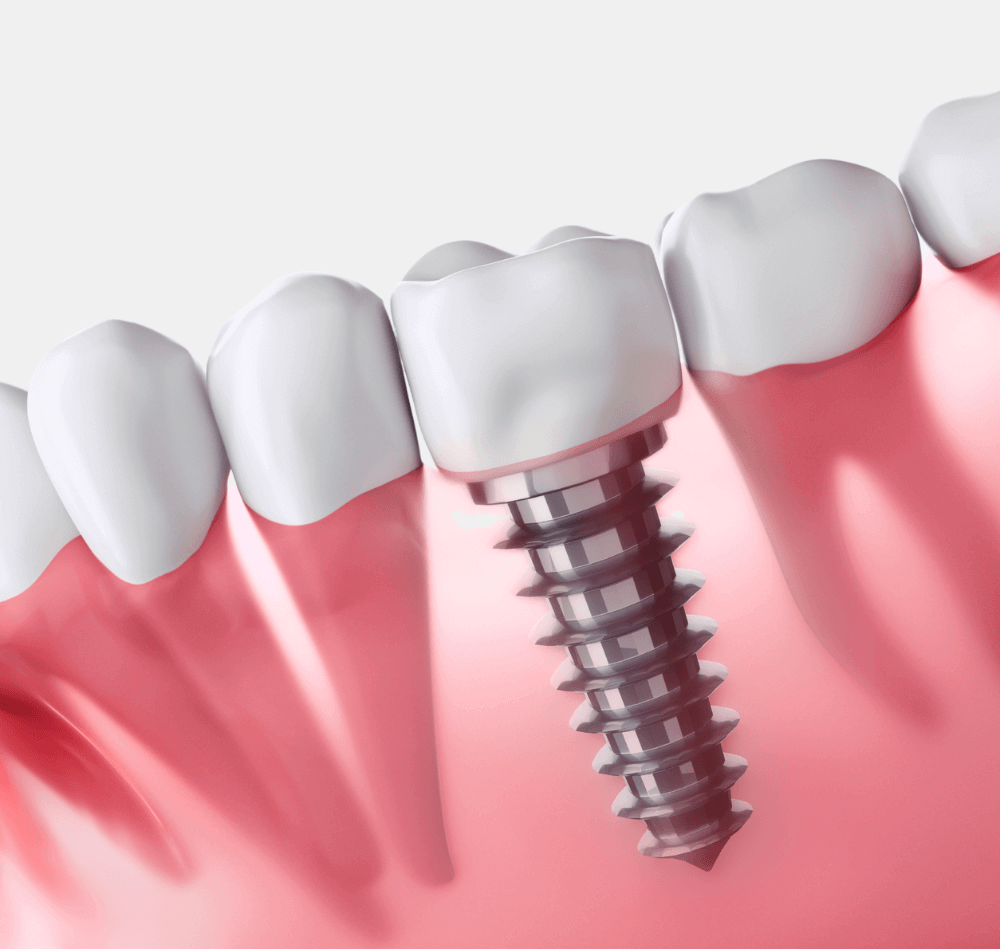 Implantate als moderne Alternative zu klassischem Zahnersatz