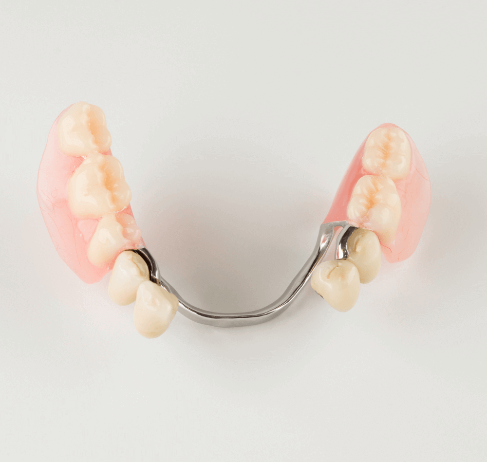 Klammerprothese als herausnehmbarer Zahnersatz bei mehreren fehlenden Zähnen