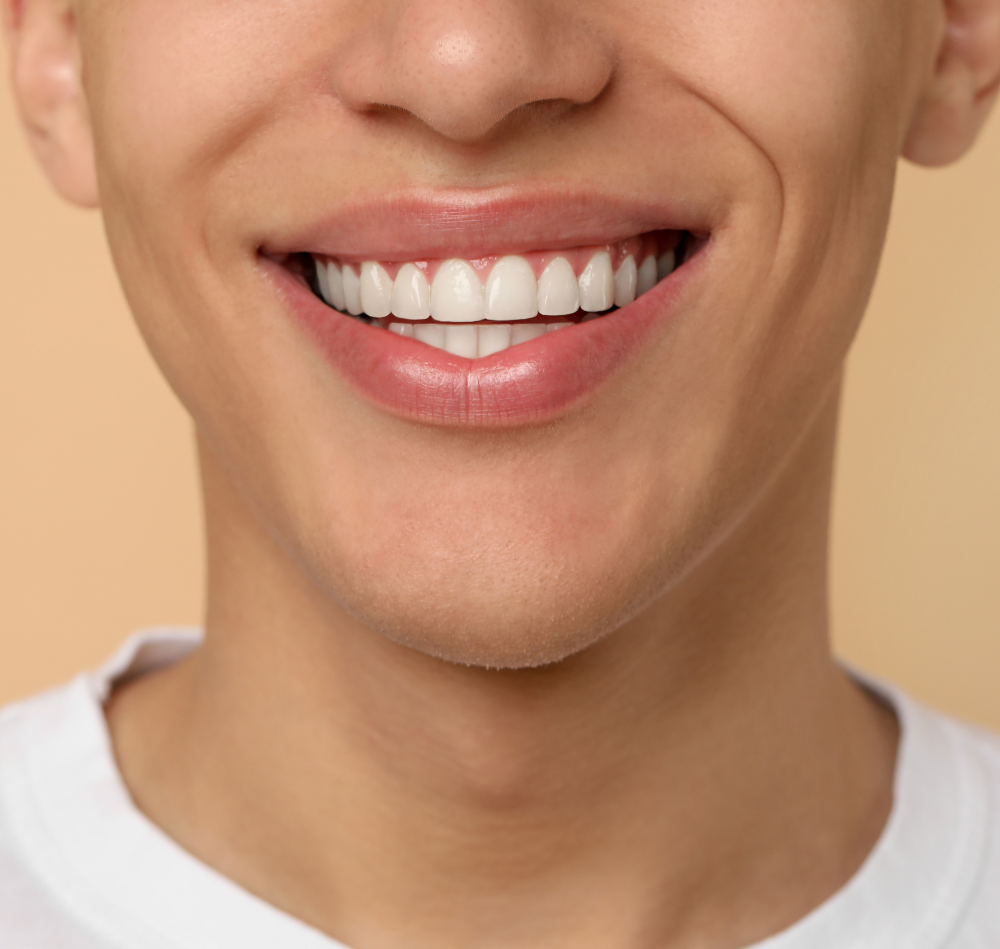 Person mit Veneers.