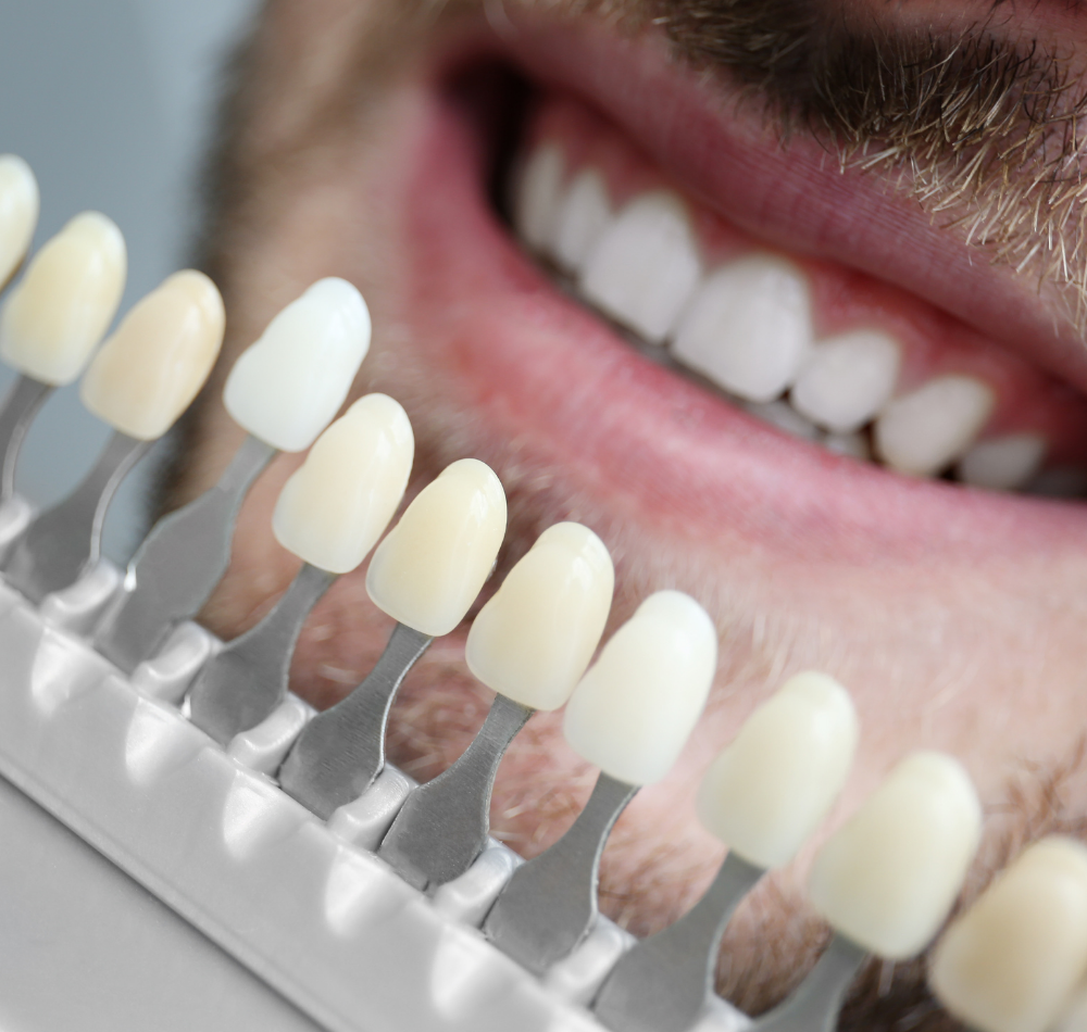 Veneers.